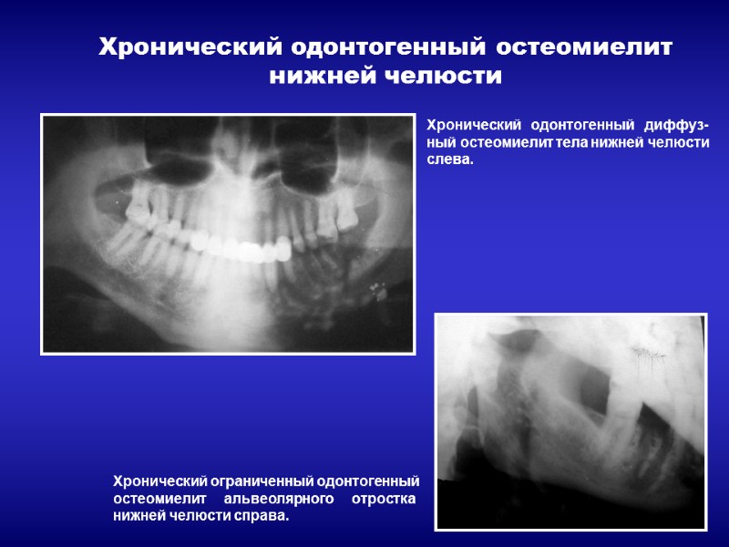 Хронический одонтогенный остеомиелит нижней челюсти Хронический   одонтогенный   диффуз- ный остеомиелит